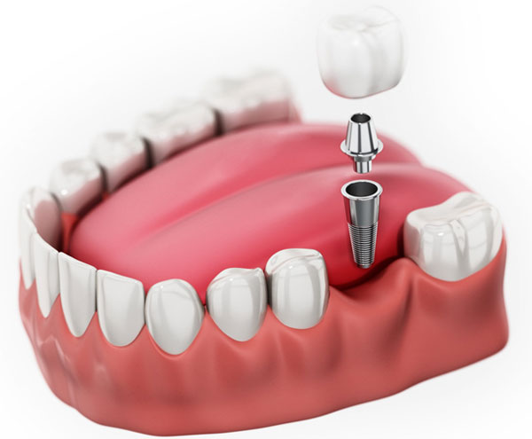 Dental Implants