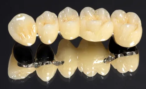 Metal ceramic crowns